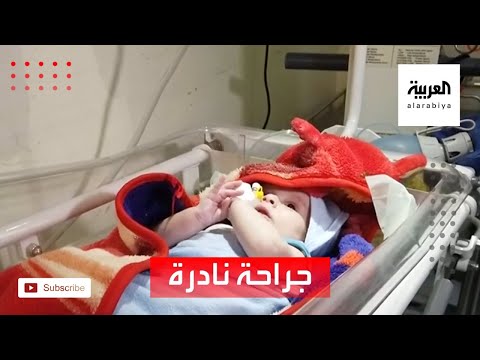 شاهد نجاح جراحة نادرة لرضيع مولود بتشوه خلقي في مأرب