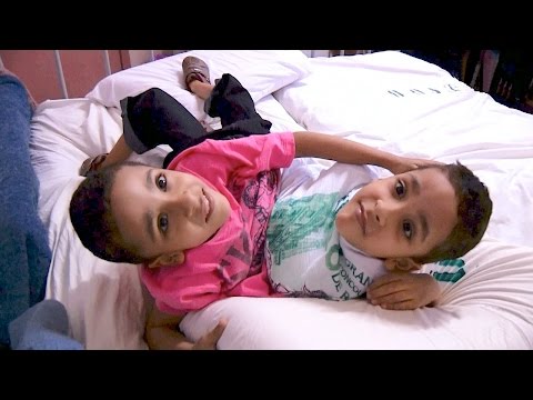 conjoined twins await separation